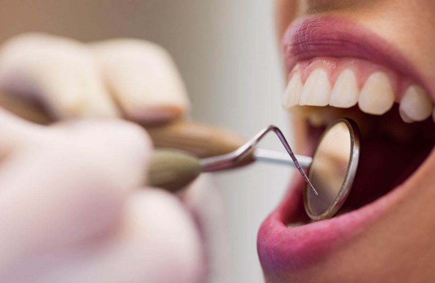 periodontal explorer dental check up