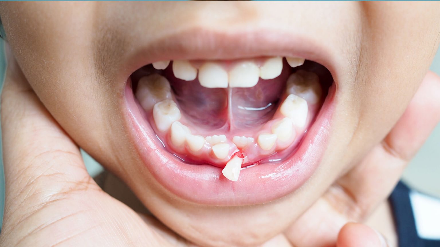 pediatric-dentistry-baby-milk-teeth-suir-clinic-waterford