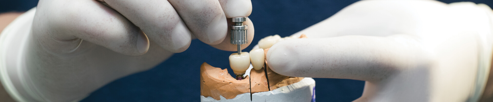 Dental implant prostho work on gypsum model
